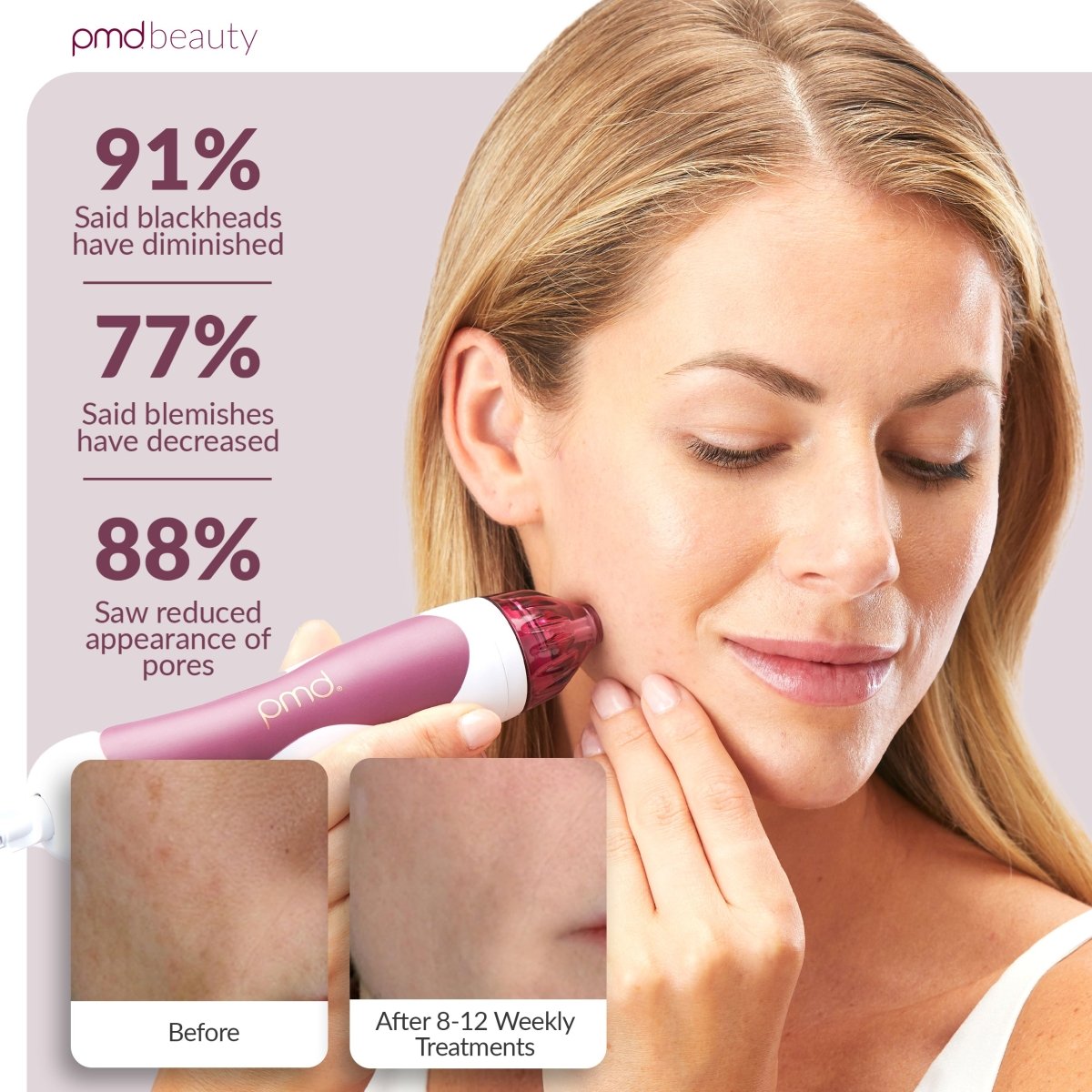 PMD Personal Microderm Clasico Microdermoabrasión en Casa para una Piel Más Suave y Radiante