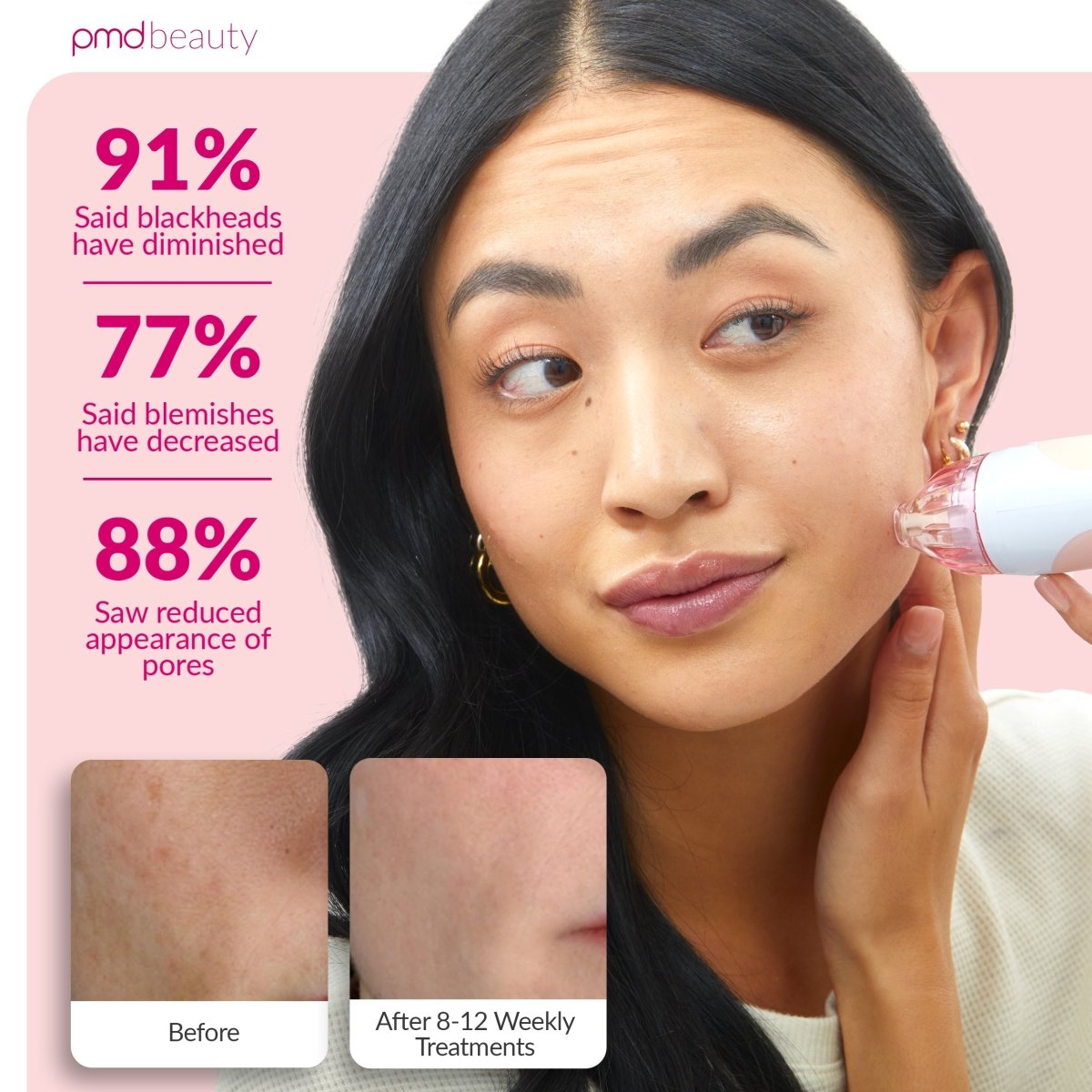 PMD Personal Microderm Clasico Microdermoabrasión en Casa para una Piel Más Suave y Radiante
