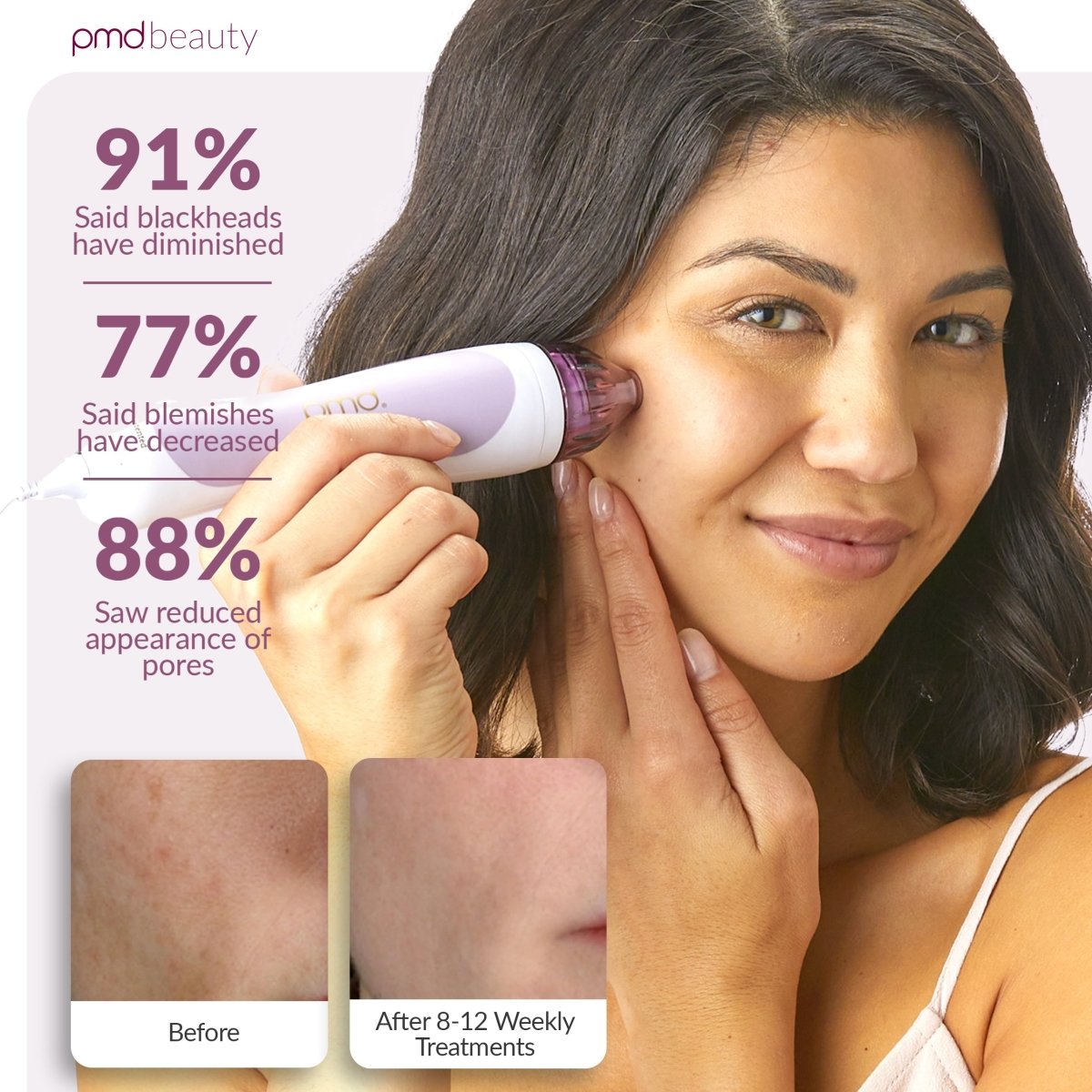 PMD Personal Microderm Clasico Microdermoabrasión en Casa para una Piel Más Suave y Radiante