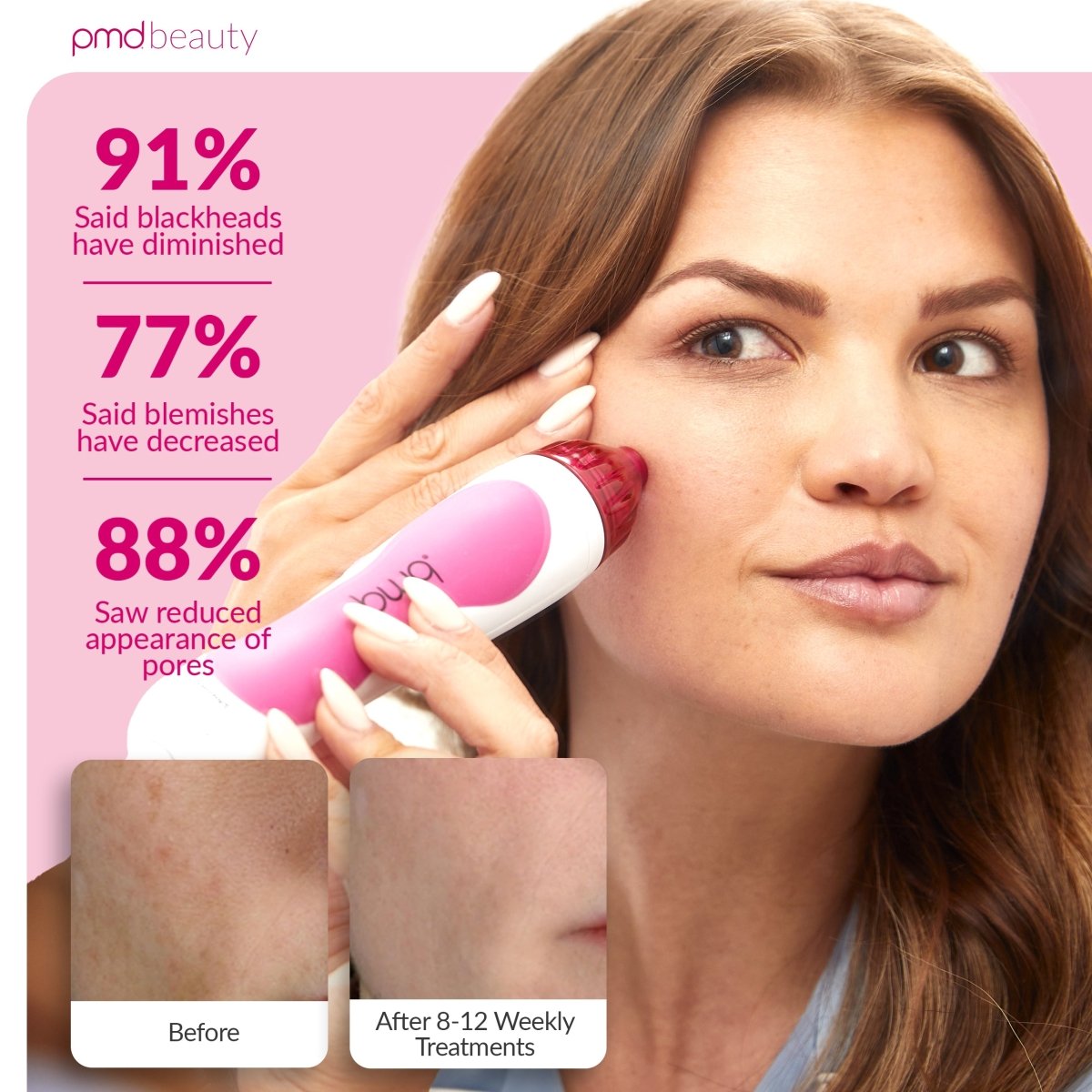 PMD Personal Microderm Clasico Microdermoabrasión en Casa para una Piel Más Suave y Radiante