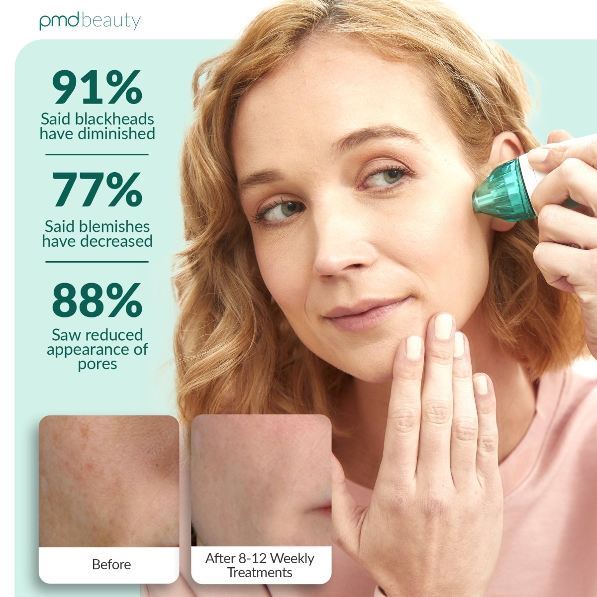 PMD Personal Microderm Clasico Microdermoabrasión en Casa para una Piel Más Suave y Radiante