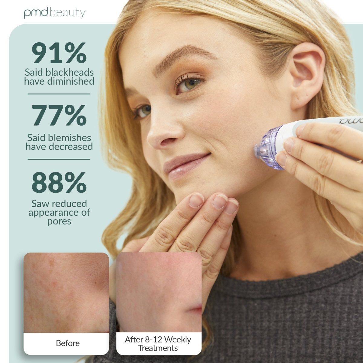PMD Personal Microderm Clasico Microdermoabrasión en Casa para una Piel Más Suave y Radiante