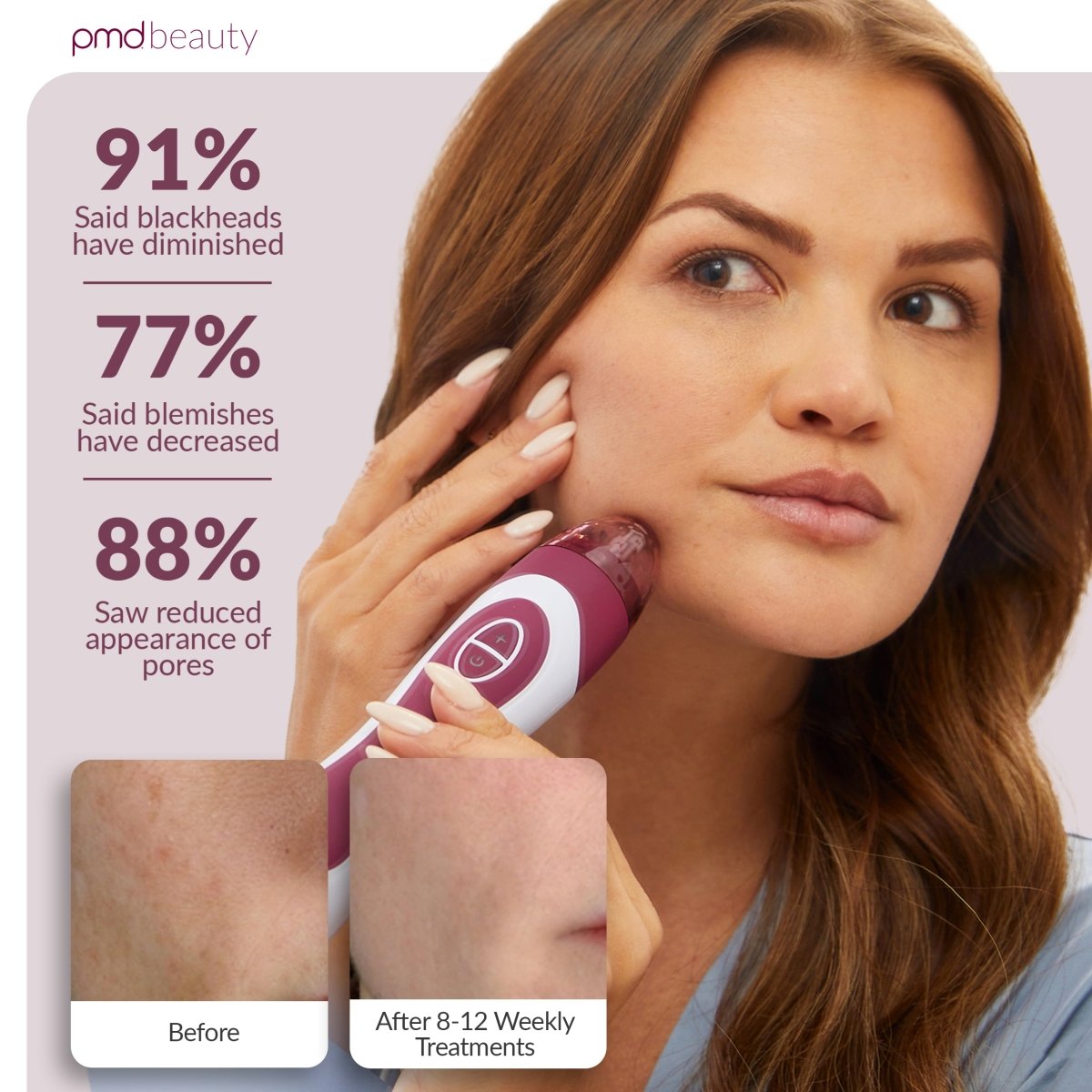 PMD Personal Microderm Elite Pro Microdermoabrasión Profesional para Rostro y Cuerpo