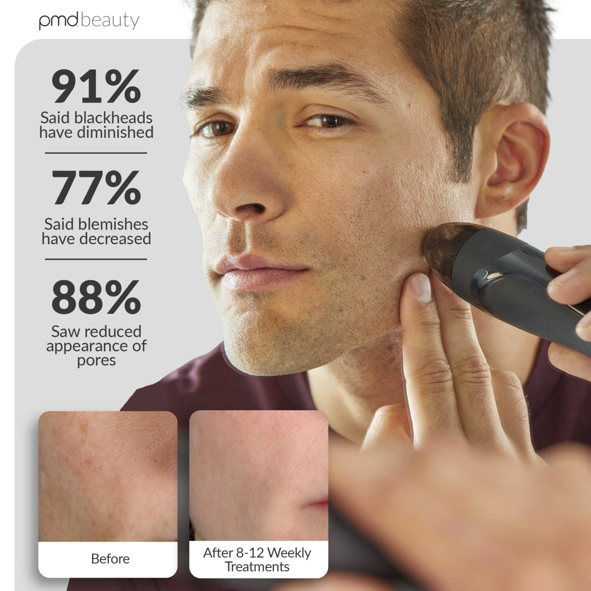 PMD Personal Microderm Elite Pro Microdermoabrasión Profesional para Rostro y Cuerpo