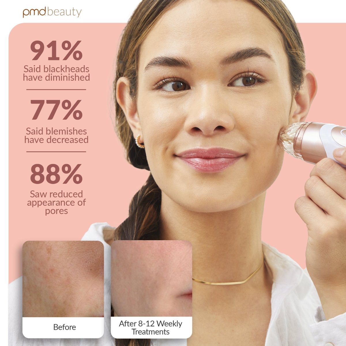 PMD Personal Microderm Elite Pro Microdermoabrasión Profesional para Rostro y Cuerpo
