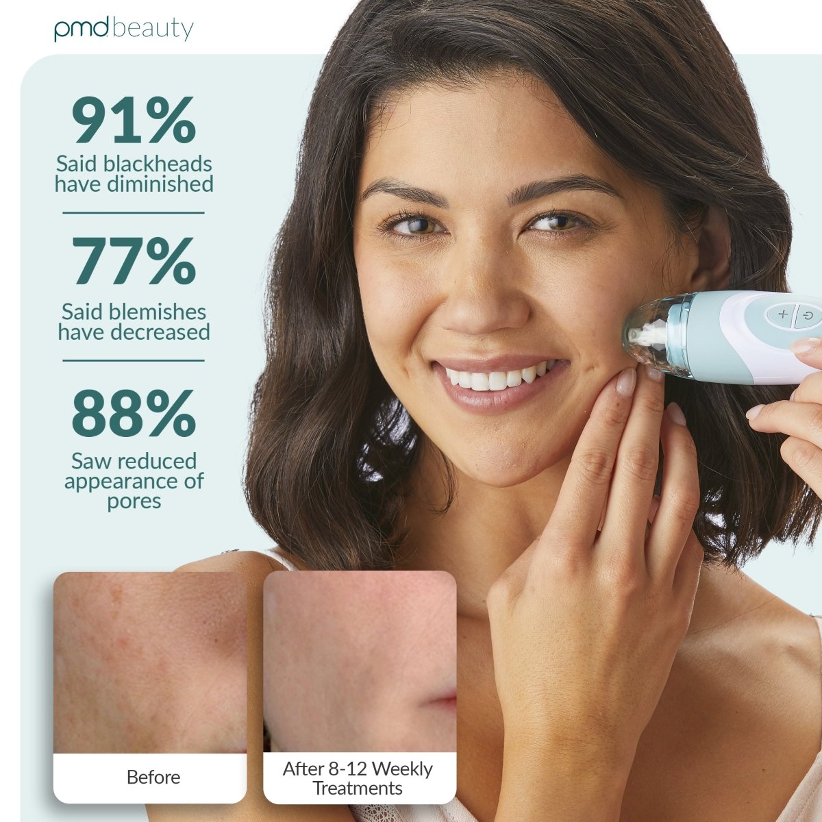 PMD Personal Microderm Elite Pro Microdermoabrasión Profesional para Rostro y Cuerpo
