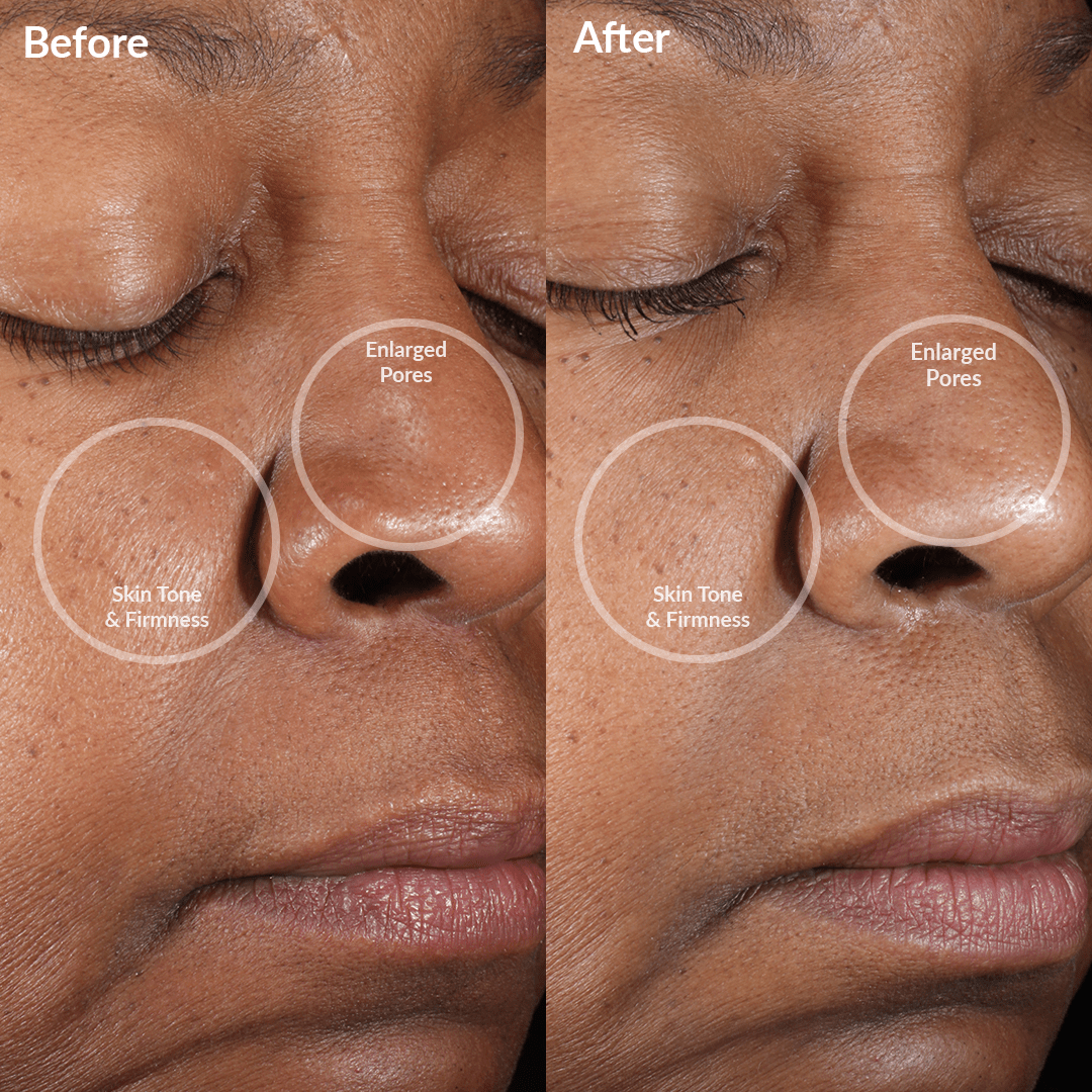 4000-PINK?Before and After Showing Results of the PMD Clean Mini