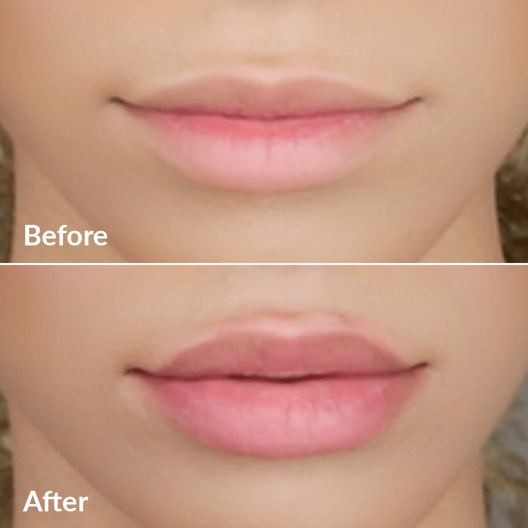 PMD Kiss | Dispositivo para Aumentar el Volumen de los Labios y Reducir Líneas Finas