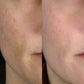 PMD Personal Microderm Clasico Microdermoabrasión en Casa para una Piel Más Suave y Radiante