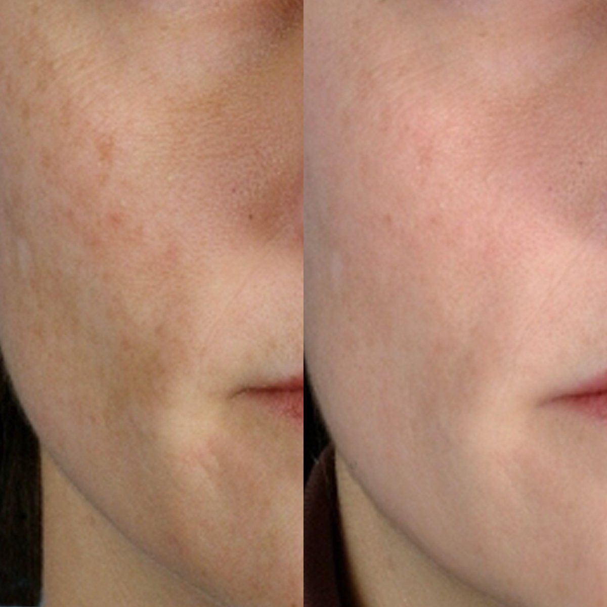 PMD Personal Microderm Clasico Microdermoabrasión en Casa para una Piel Más Suave y Radiante